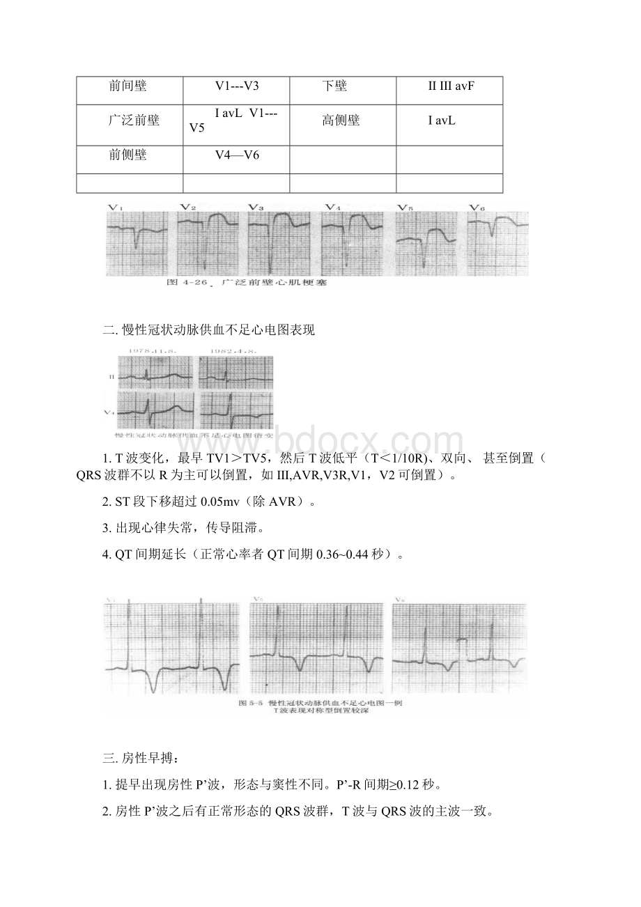 常见心电图特点及波形.docx_第3页