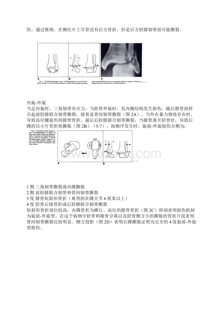 踝关节骨折分类系统LaugeHansen分型.docx_第2页