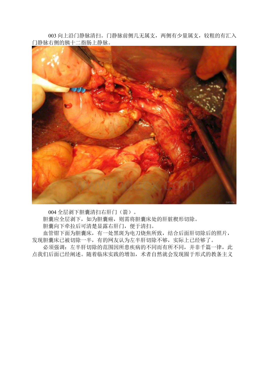 肝脏手术肝门部胆管癌根治性切除术及胆囊癌根治术.docx_第3页