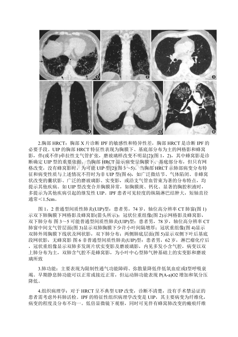 特发性肺纤维化诊疗专家共识Word文件下载.docx_第3页