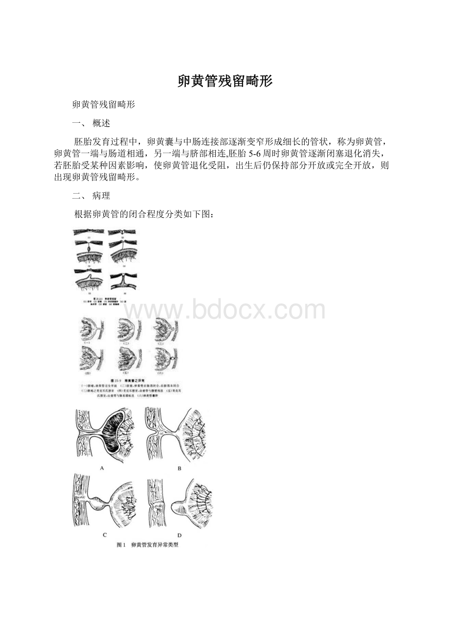 卵黄管残留畸形.docx