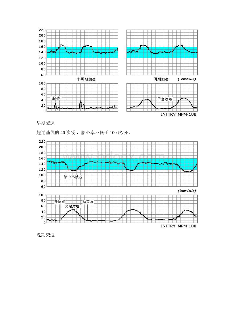 胎心监护图谱.docx_第2页