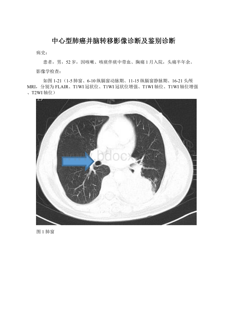 中心型肺癌并脑转移影像诊断及鉴别诊断Word文档格式.docx_第1页