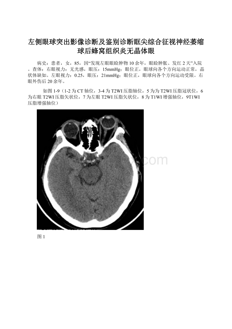 左侧眼球突出影像诊断及鉴别诊断眶尖综合征视神经萎缩球后蜂窝组织炎无晶体眼文档格式.docx_第1页