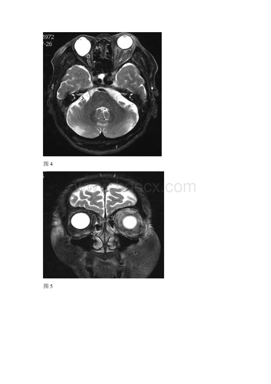 左侧眼球突出影像诊断及鉴别诊断眶尖综合征视神经萎缩球后蜂窝组织炎无晶体眼文档格式.docx_第3页