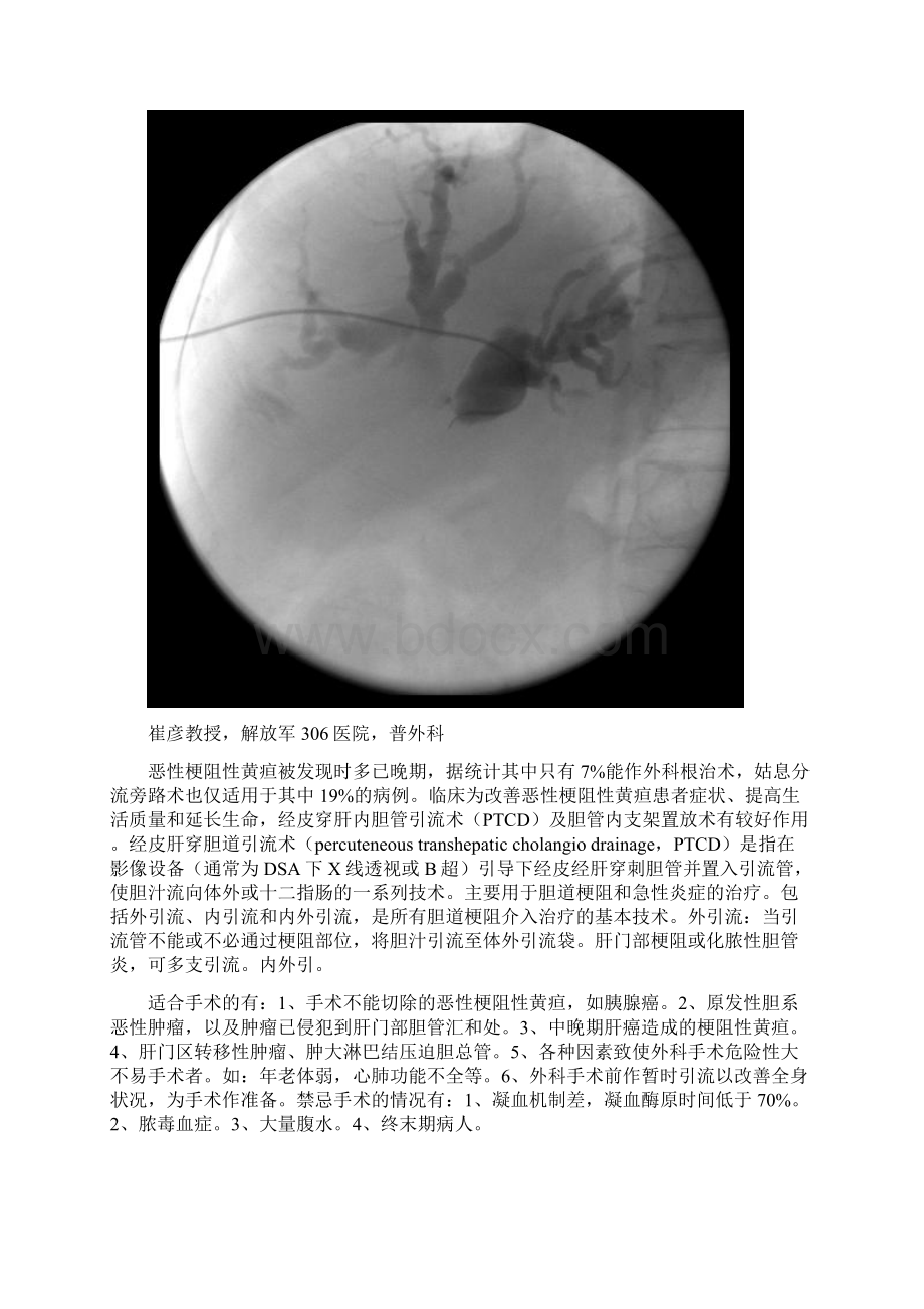 经皮穿刺肝胆管引流术.docx_第2页