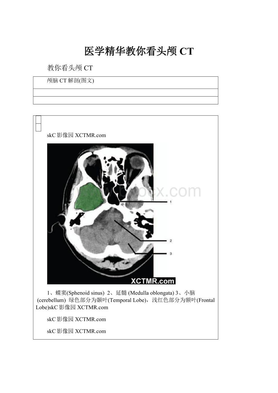 医学精华教你看头颅CT.docx_第1页