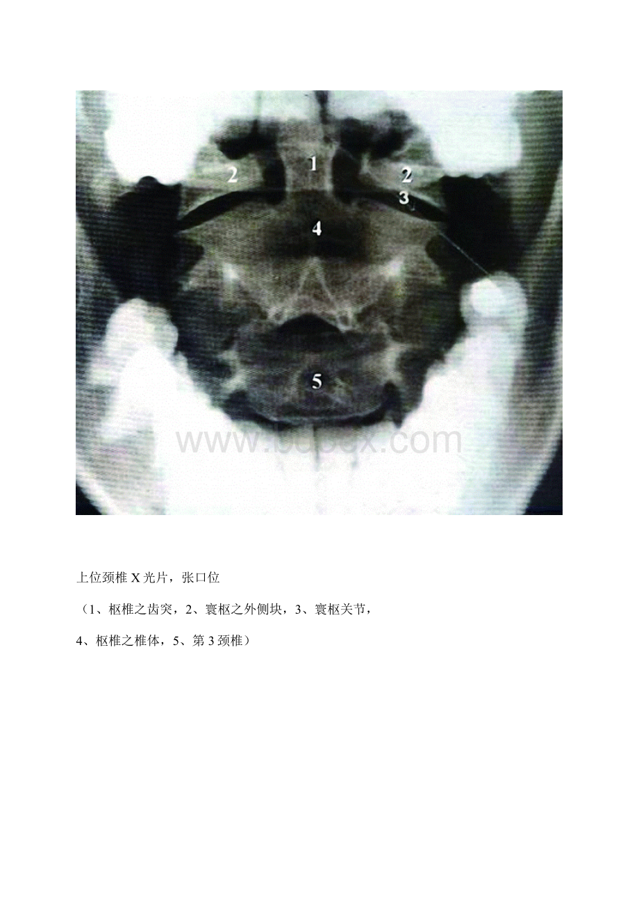 全脊柱影像学诊断.docx_第3页