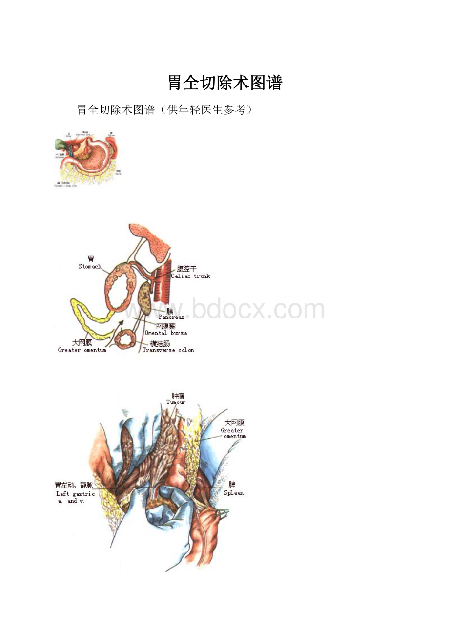 胃全切除术图谱Word文档下载推荐.docx