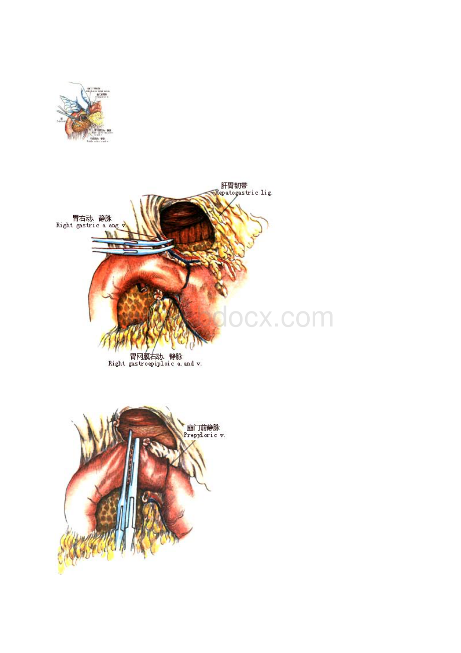 胃全切除术图谱Word文档下载推荐.docx_第2页