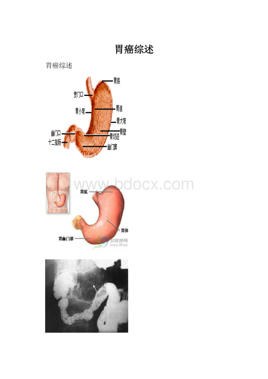 胃癌综述文档格式.docx