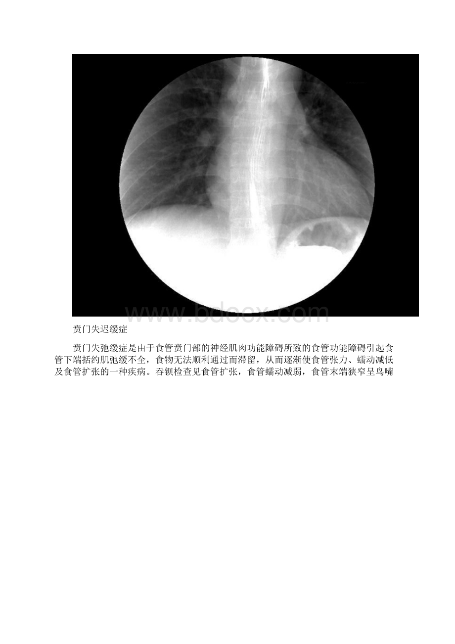 分钟读懂消化道造影片食管篇之欧阳生创编.docx_第2页