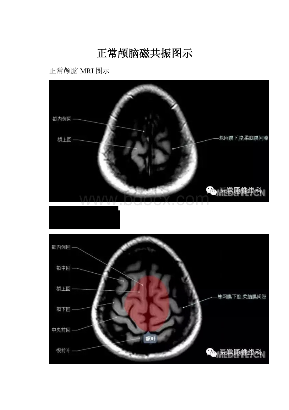 正常颅脑磁共振图示Word文件下载.docx_第1页