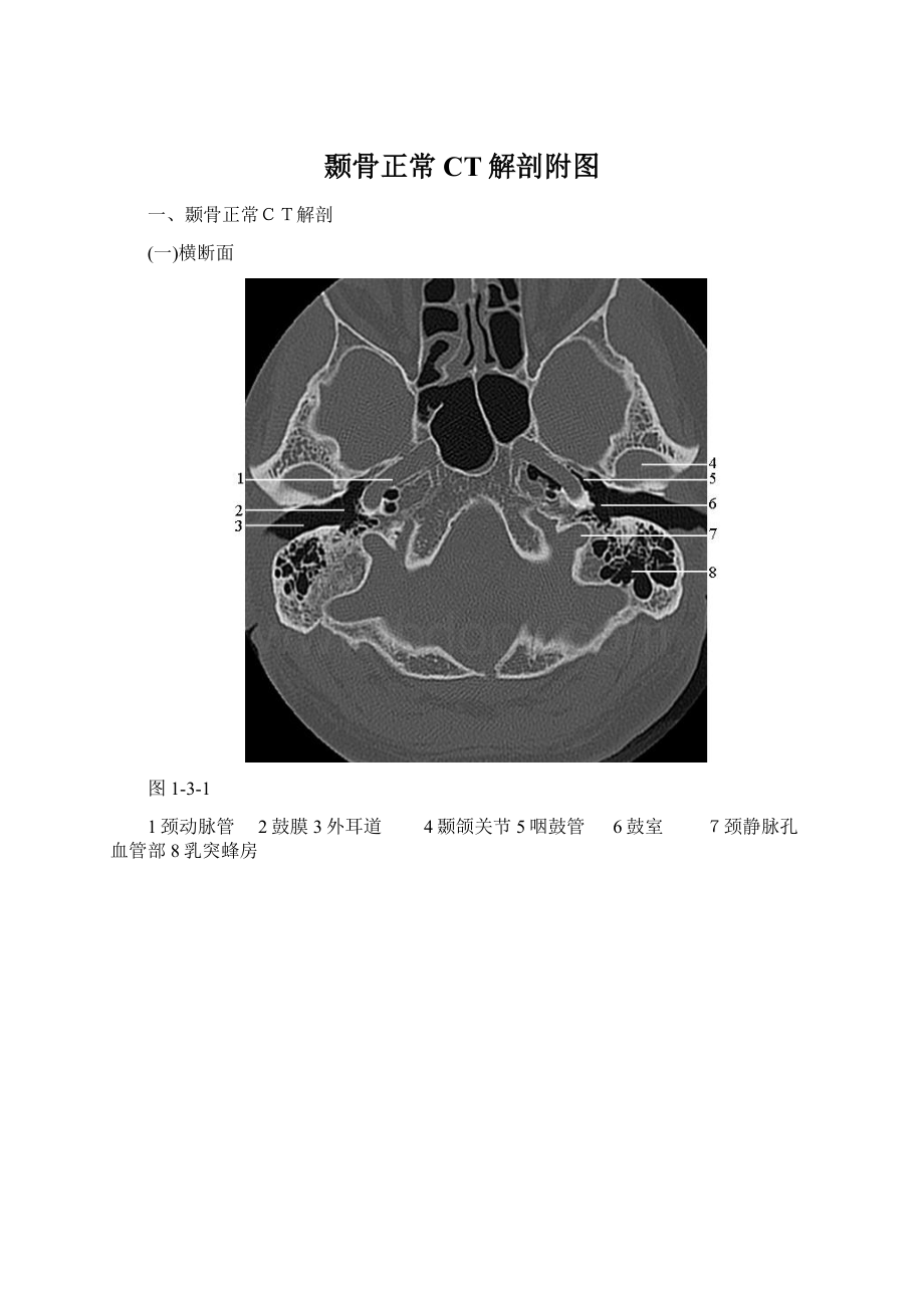 颞骨正常CT解剖附图Word格式文档下载.docx