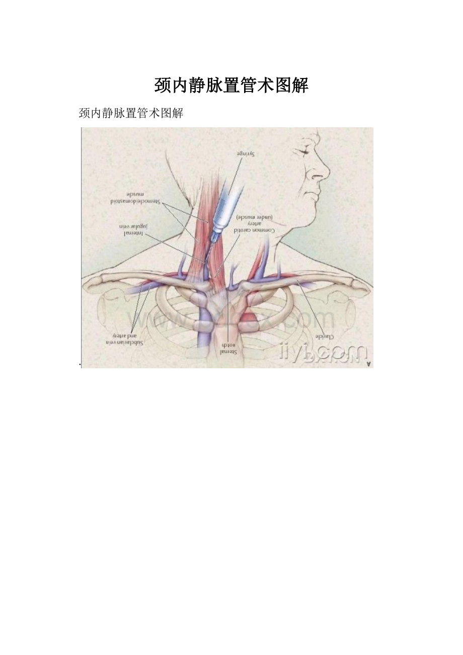 颈内静脉置管术图解.docx_第1页