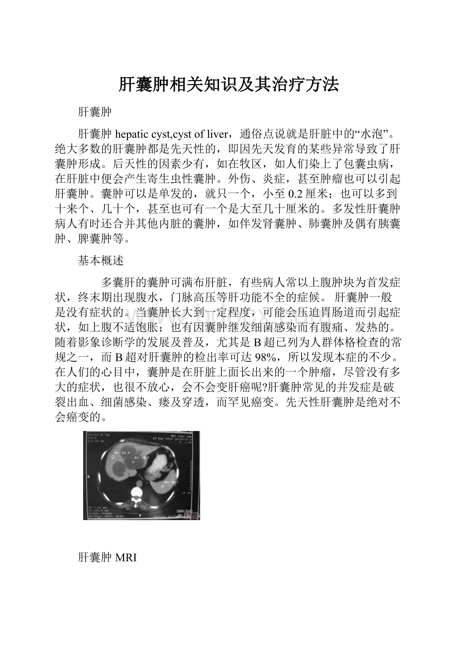 肝囊肿相关知识及其治疗方法.docx_第1页