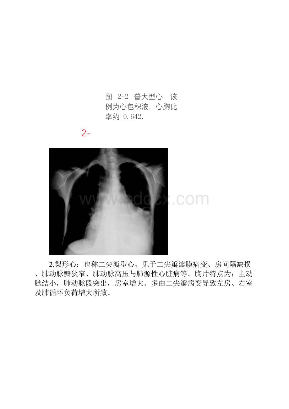 常见的X线胸片.docx_第3页