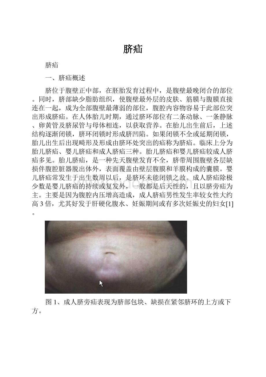 脐疝Word格式文档下载.docx