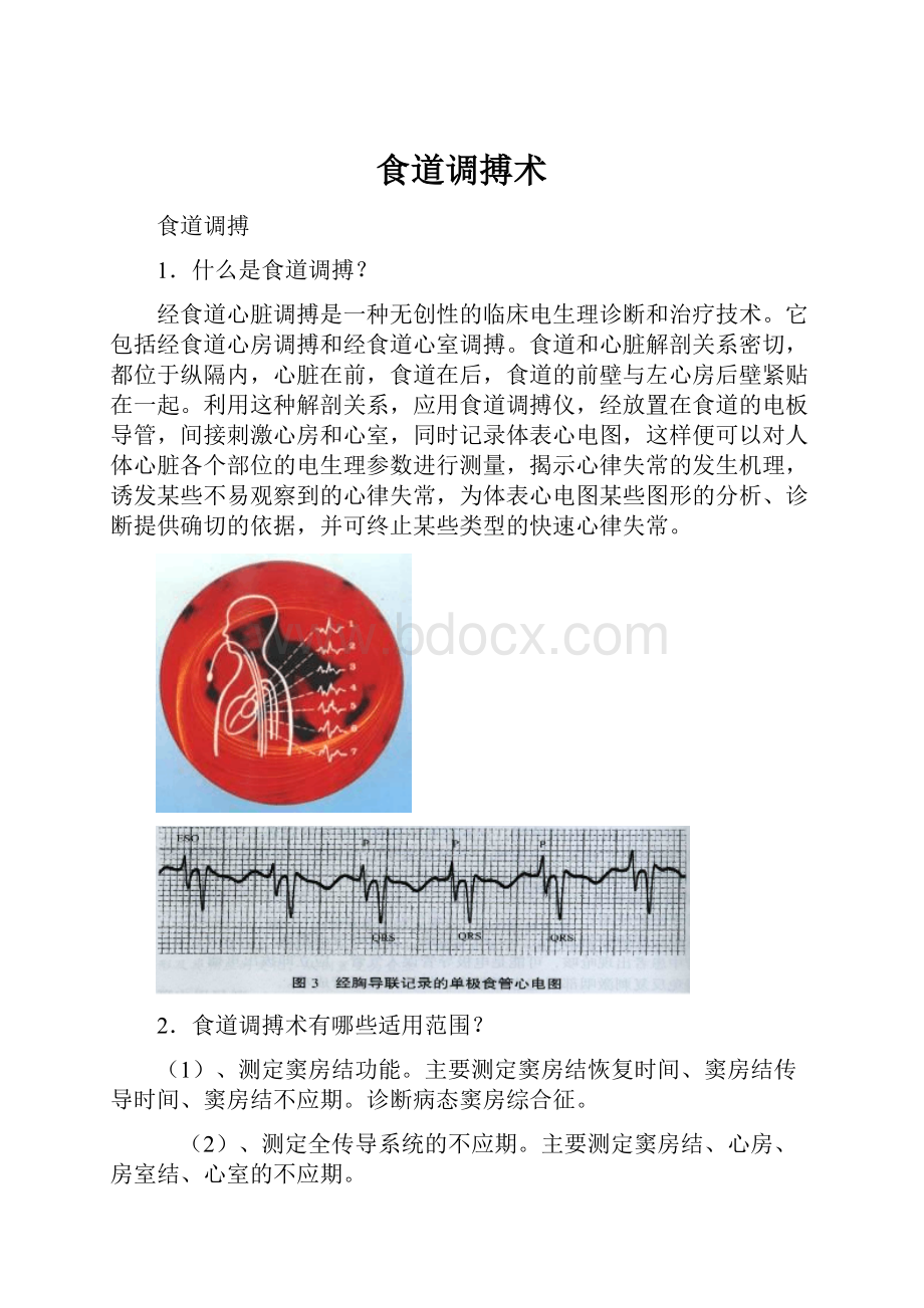 食道调搏术Word格式文档下载.docx_第1页