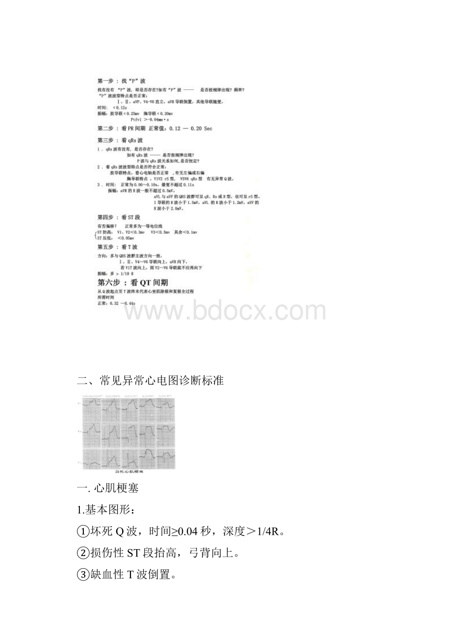 常见心电图特点及波形.docx_第2页