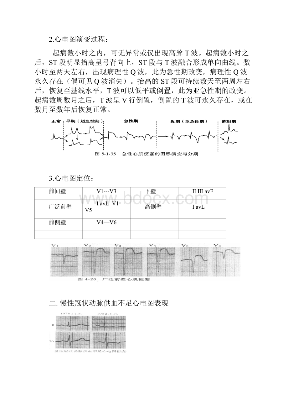 常见心电图特点及波形.docx_第3页