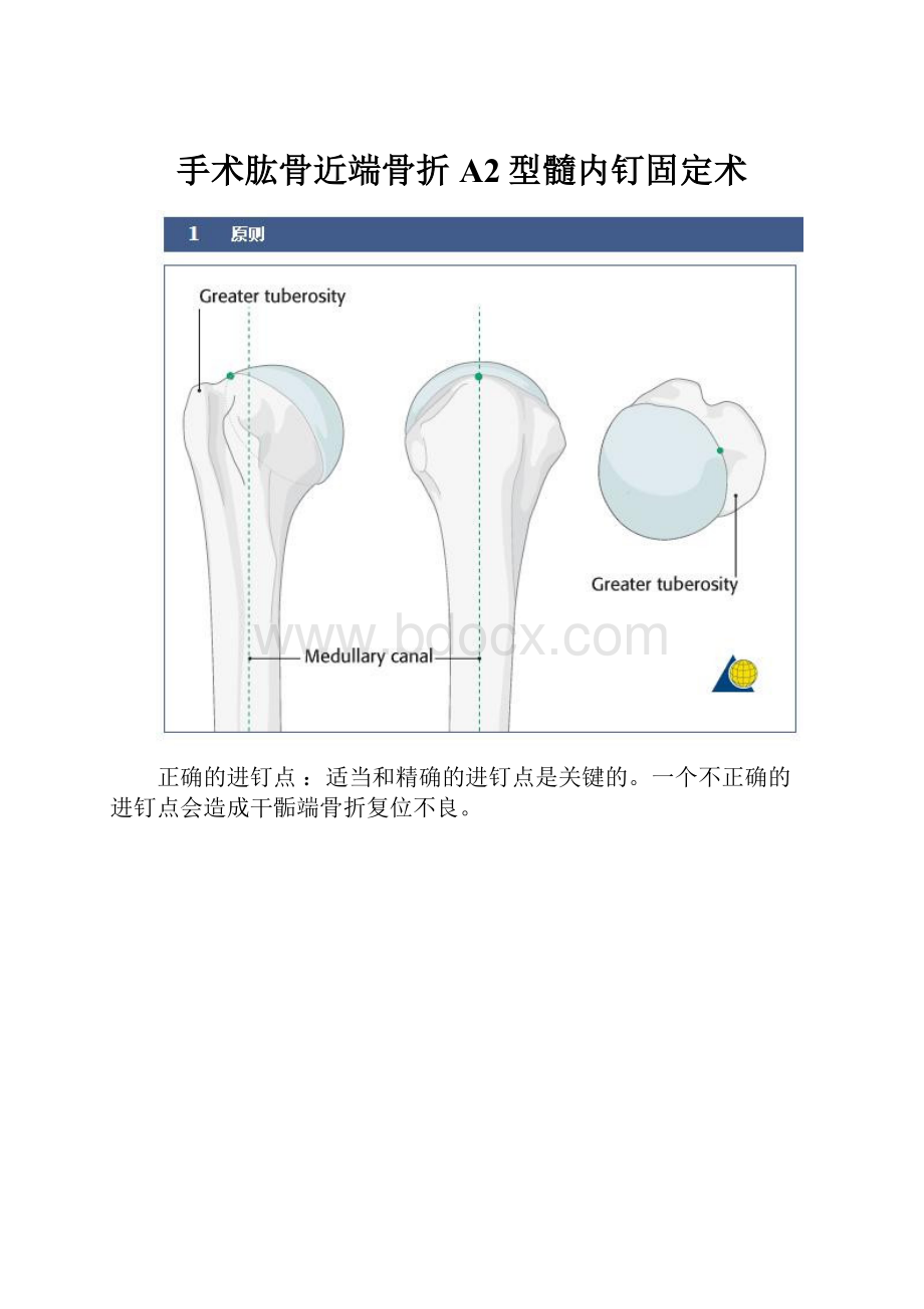 手术肱骨近端骨折A2型髓内钉固定术.docx_第1页