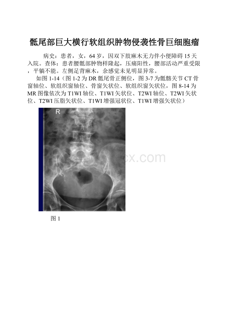 骶尾部巨大横行软组织肿物侵袭性骨巨细胞瘤.docx_第1页