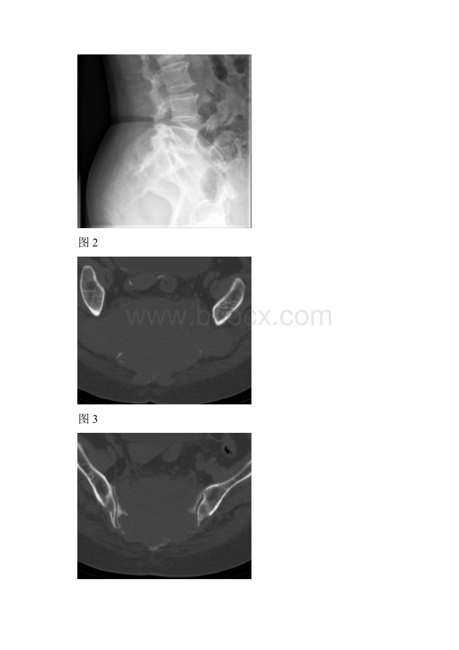 骶尾部巨大横行软组织肿物侵袭性骨巨细胞瘤.docx_第2页