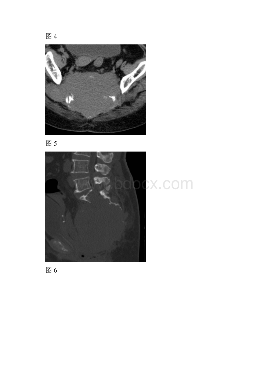骶尾部巨大横行软组织肿物侵袭性骨巨细胞瘤.docx_第3页