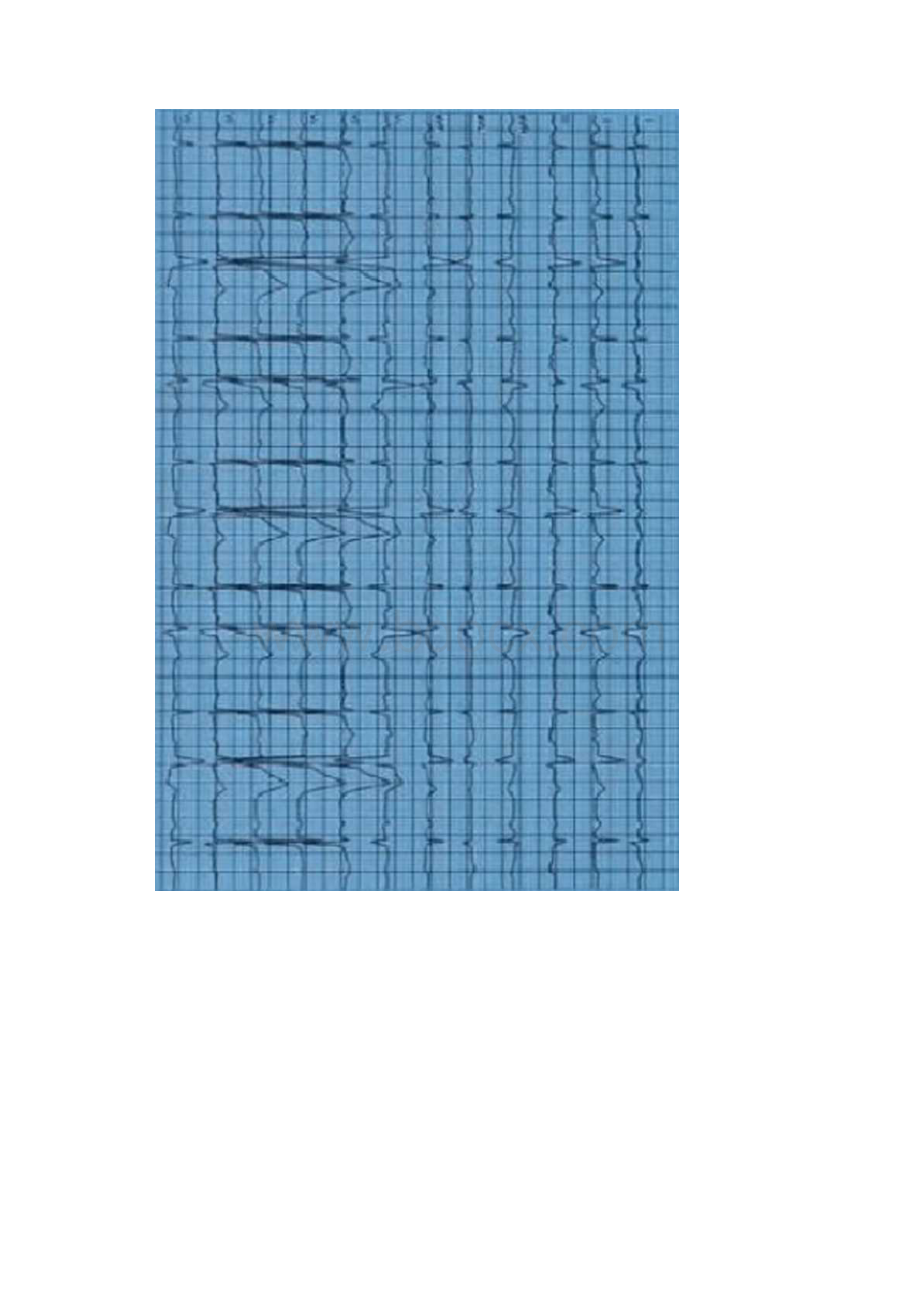 特殊心电图诊断与鉴别诊断Word格式文档下载.docx_第3页