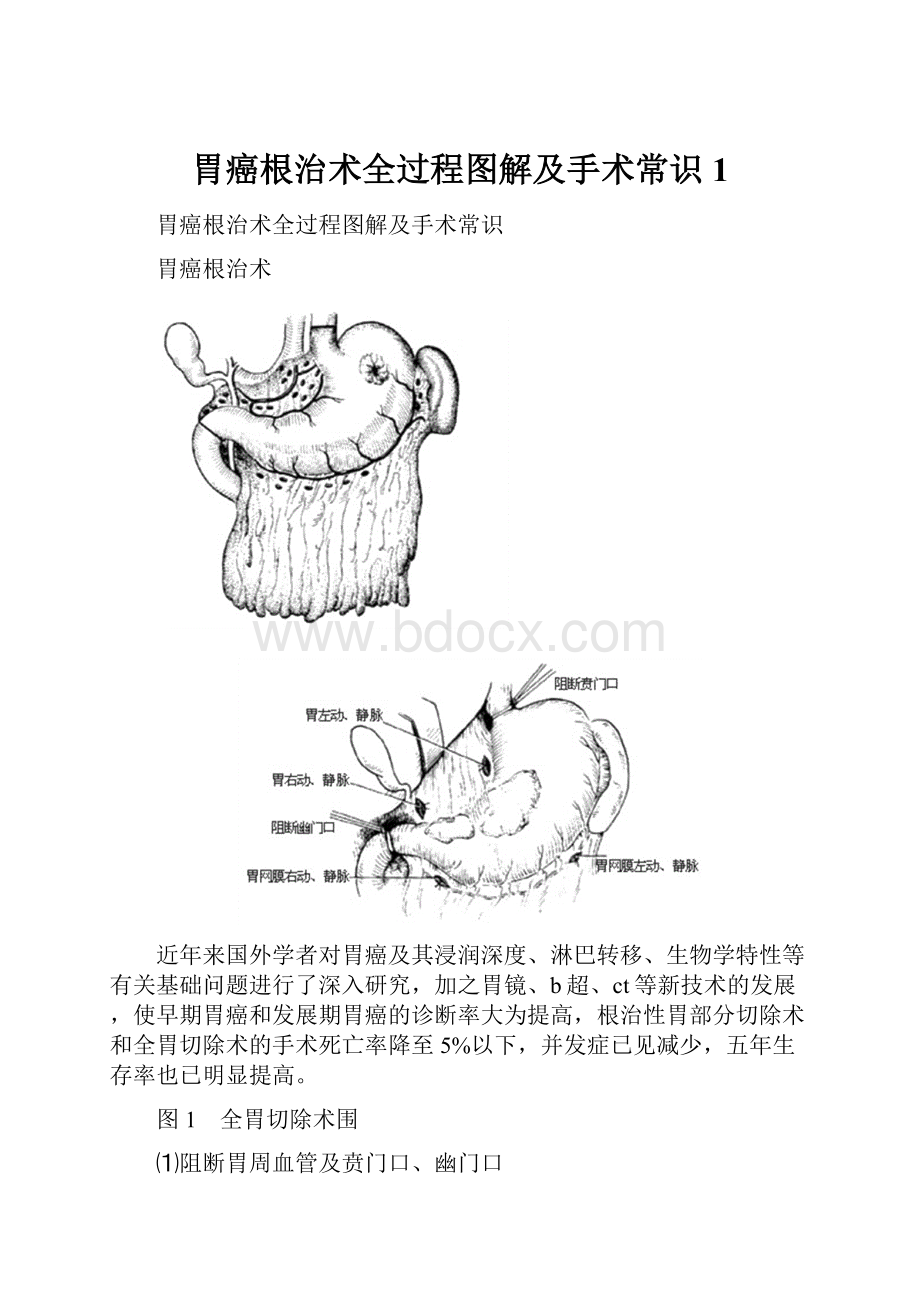 胃癌根治术全过程图解及手术常识1.docx