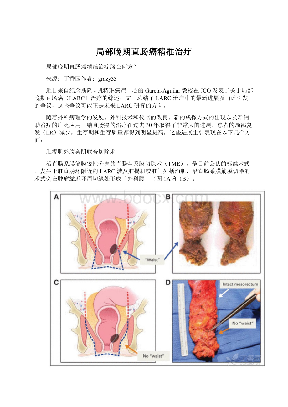 局部晚期直肠癌精准治疗.docx