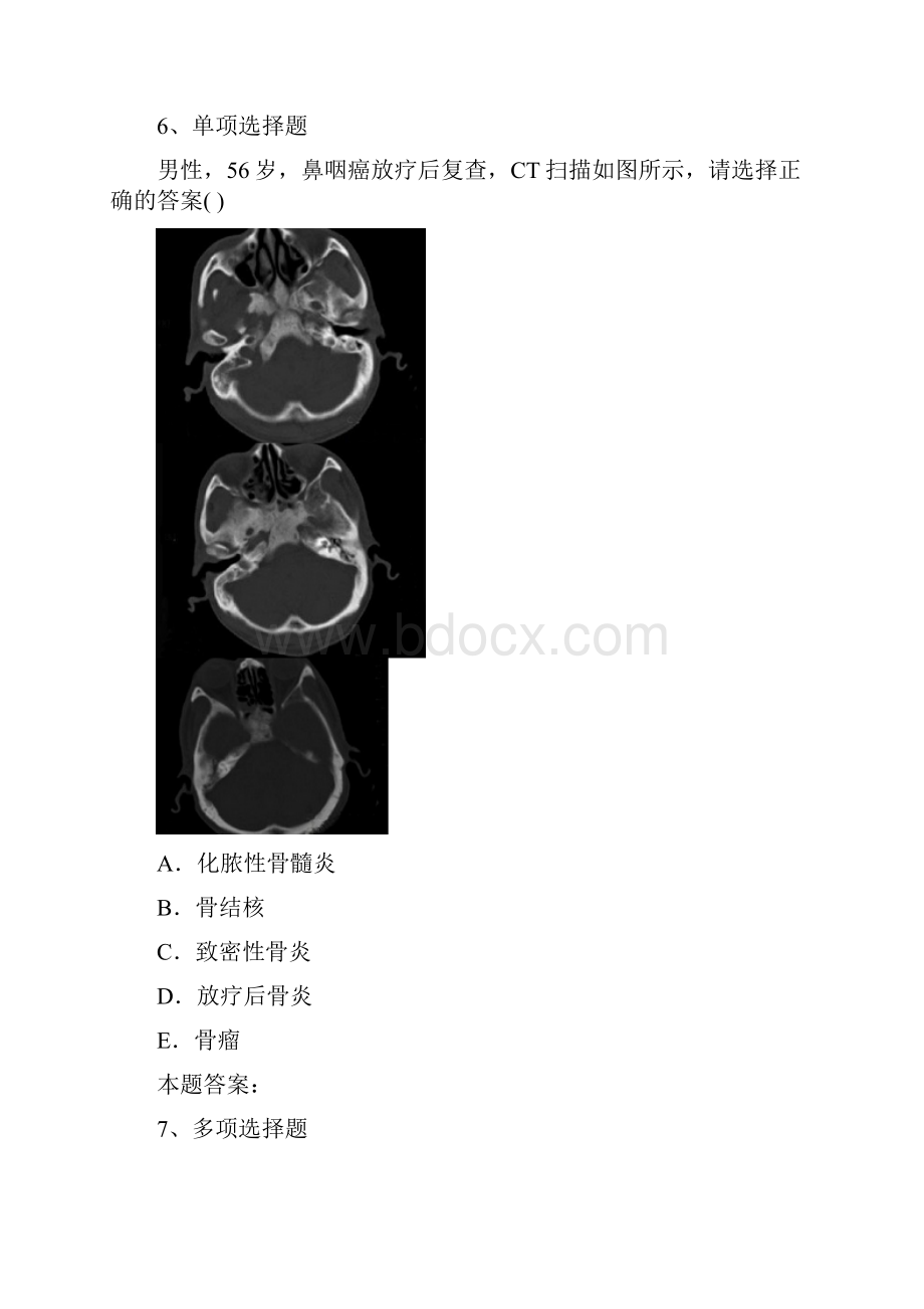 耳鼻咽喉科医学高级咽肿瘤考考试题doc.docx_第3页