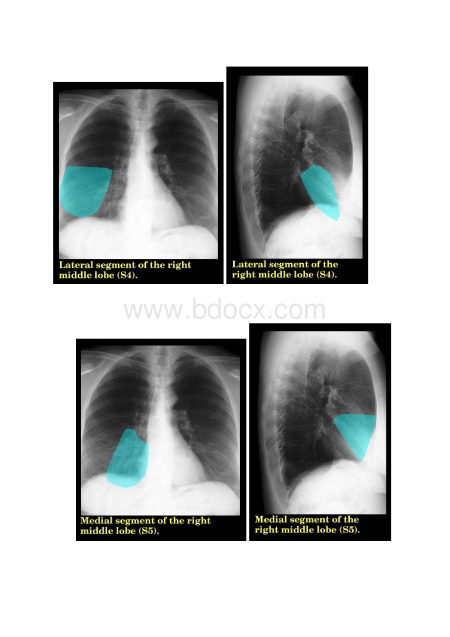 正常肺段图片X线Word格式文档下载.docx_第3页