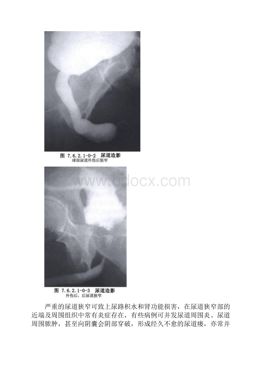 尿道狭窄扩张术最新.docx_第3页