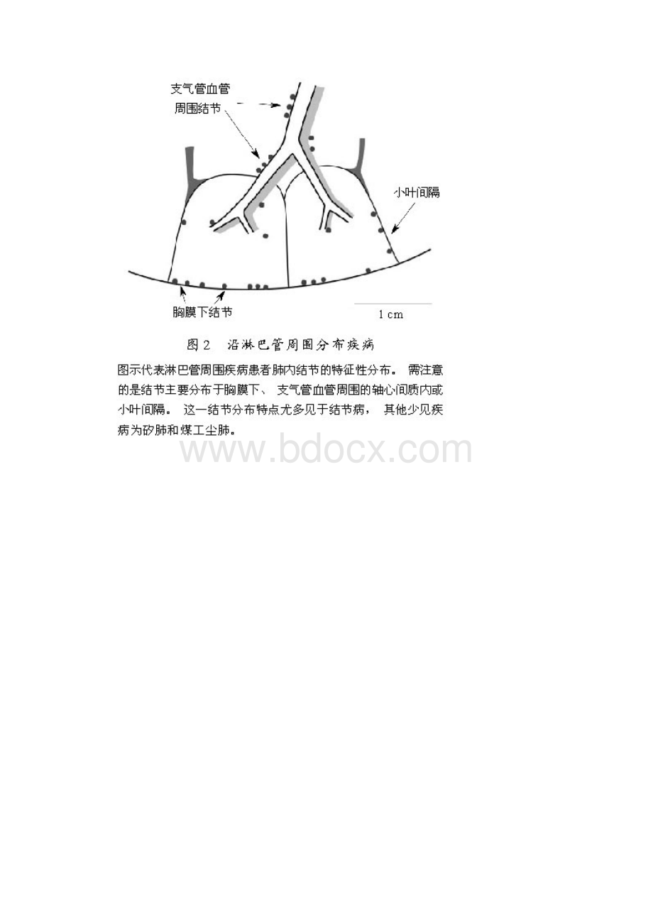 肺内多发结节的HRCT诊断及鉴别诊断流程.docx_第3页