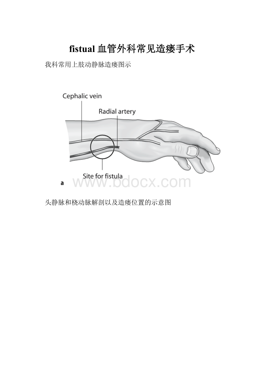 fistual血管外科常见造瘘手术.docx_第1页