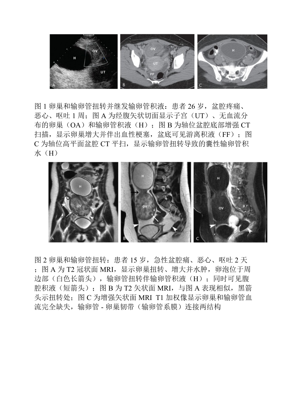 子宫附件影像学诊断误区.docx_第3页