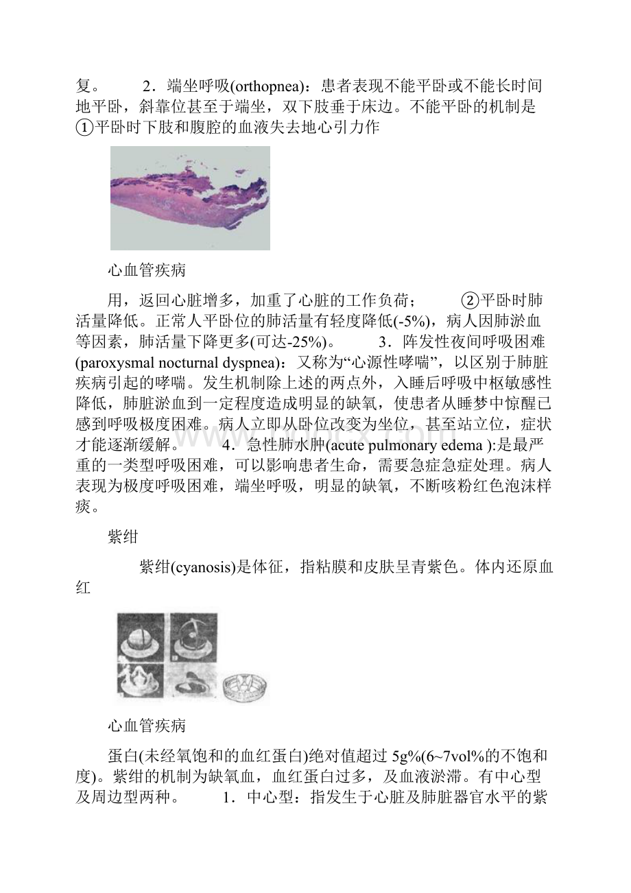 心血管疾病的分类及预防.docx_第2页