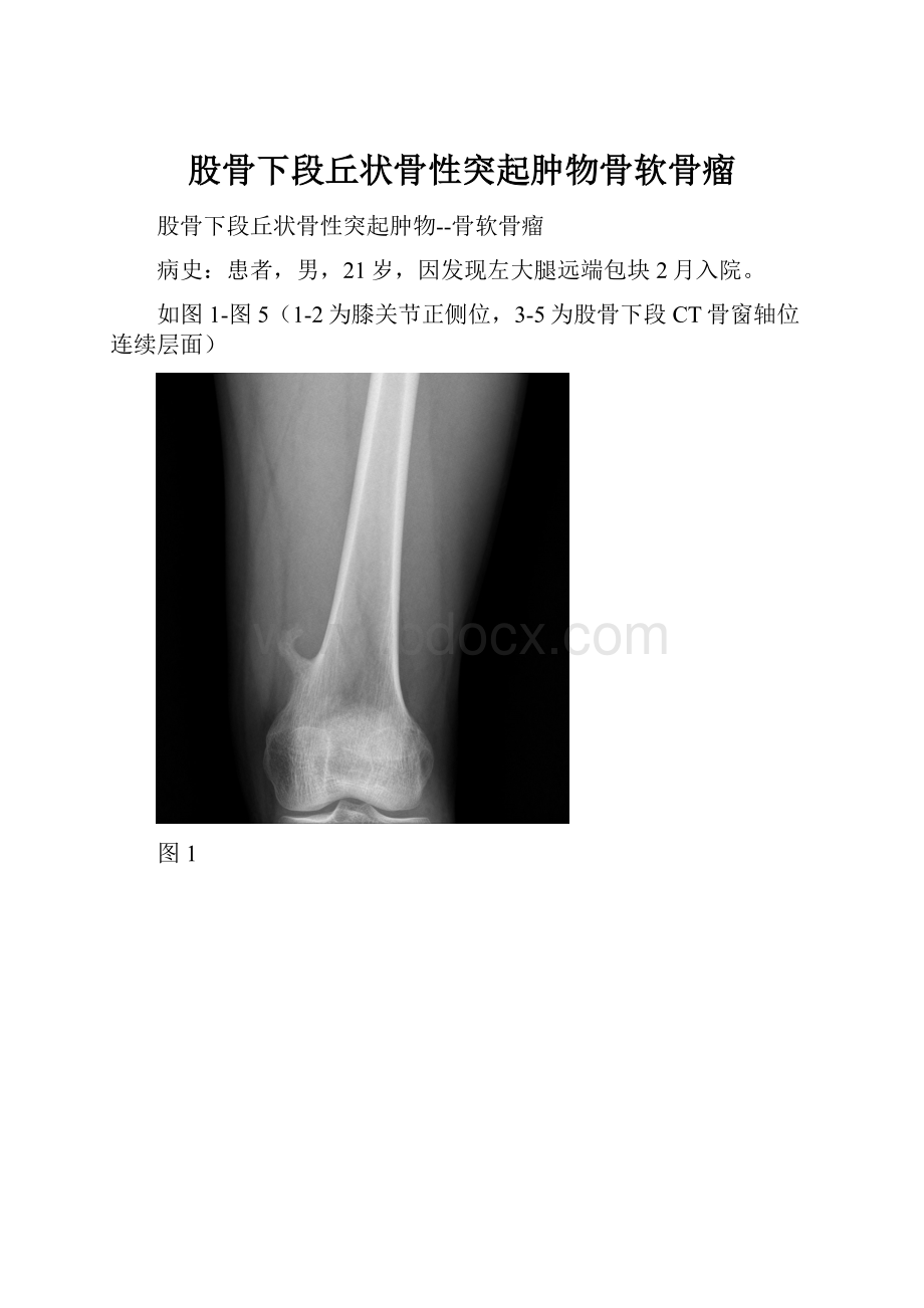 股骨下段丘状骨性突起肿物骨软骨瘤.docx