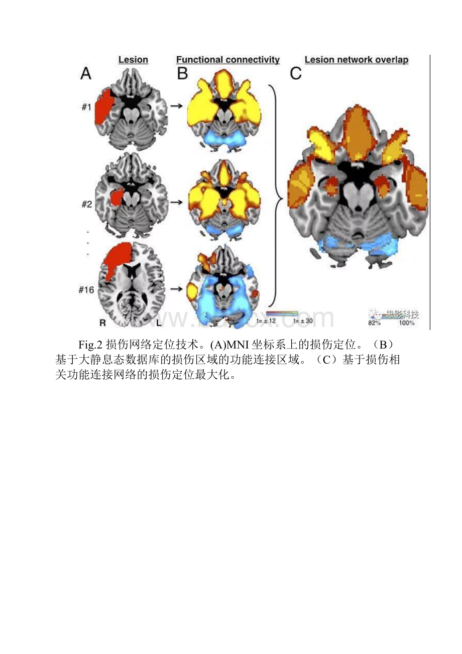 犯罪行为的脑损伤网络定位.docx_第3页