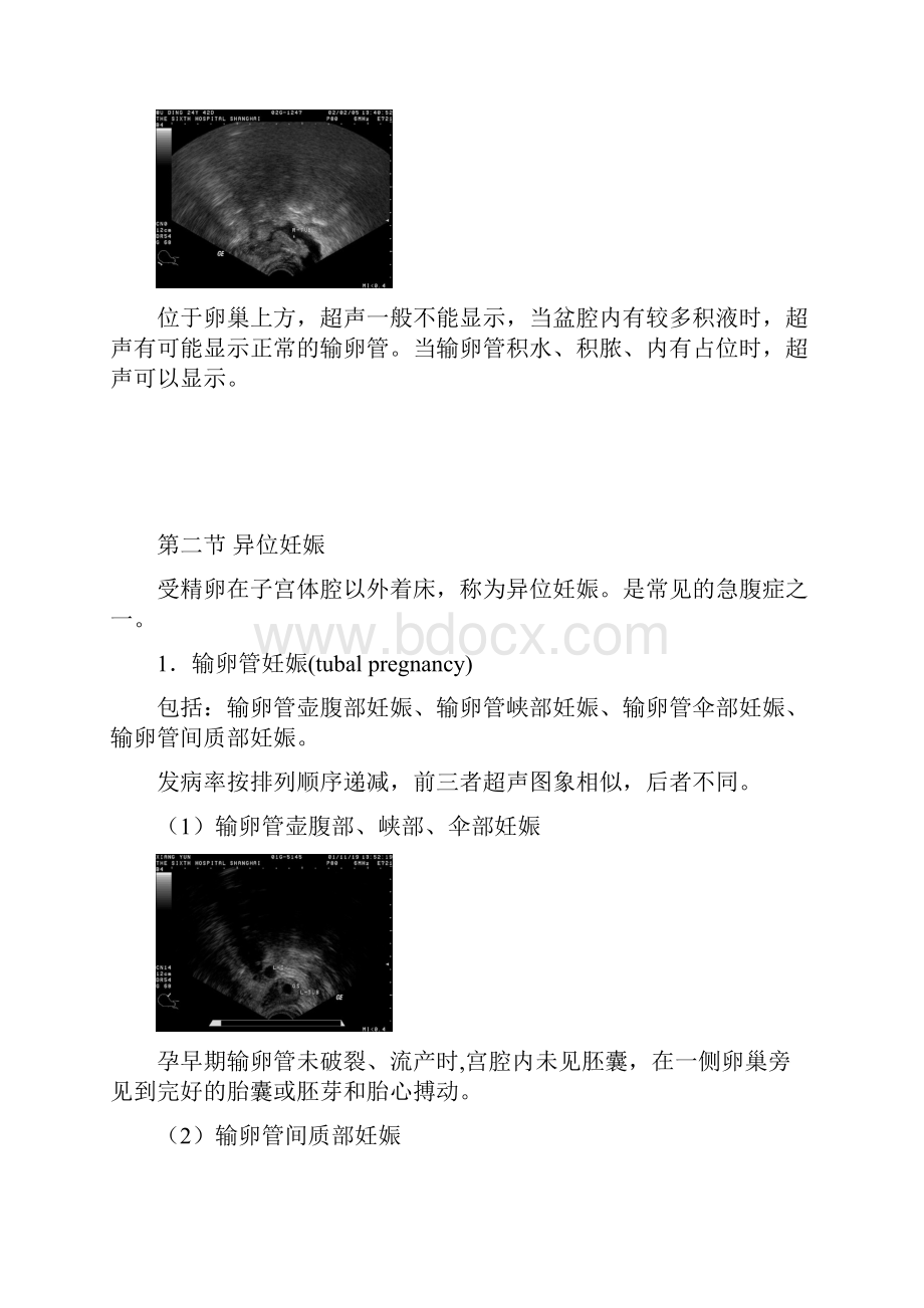 超声诊断学教程第六章子宫及其附件疾病超声诊断.docx_第2页