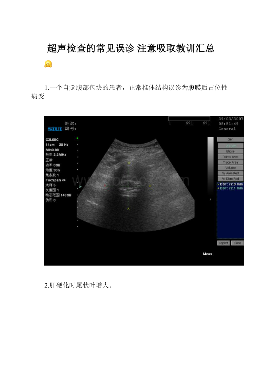 超声检查的常见误诊 注意吸取教训汇总.docx_第1页