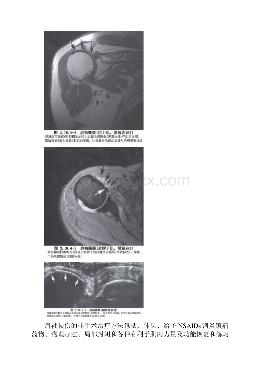 肩关节镜概述文档格式.docx_第3页