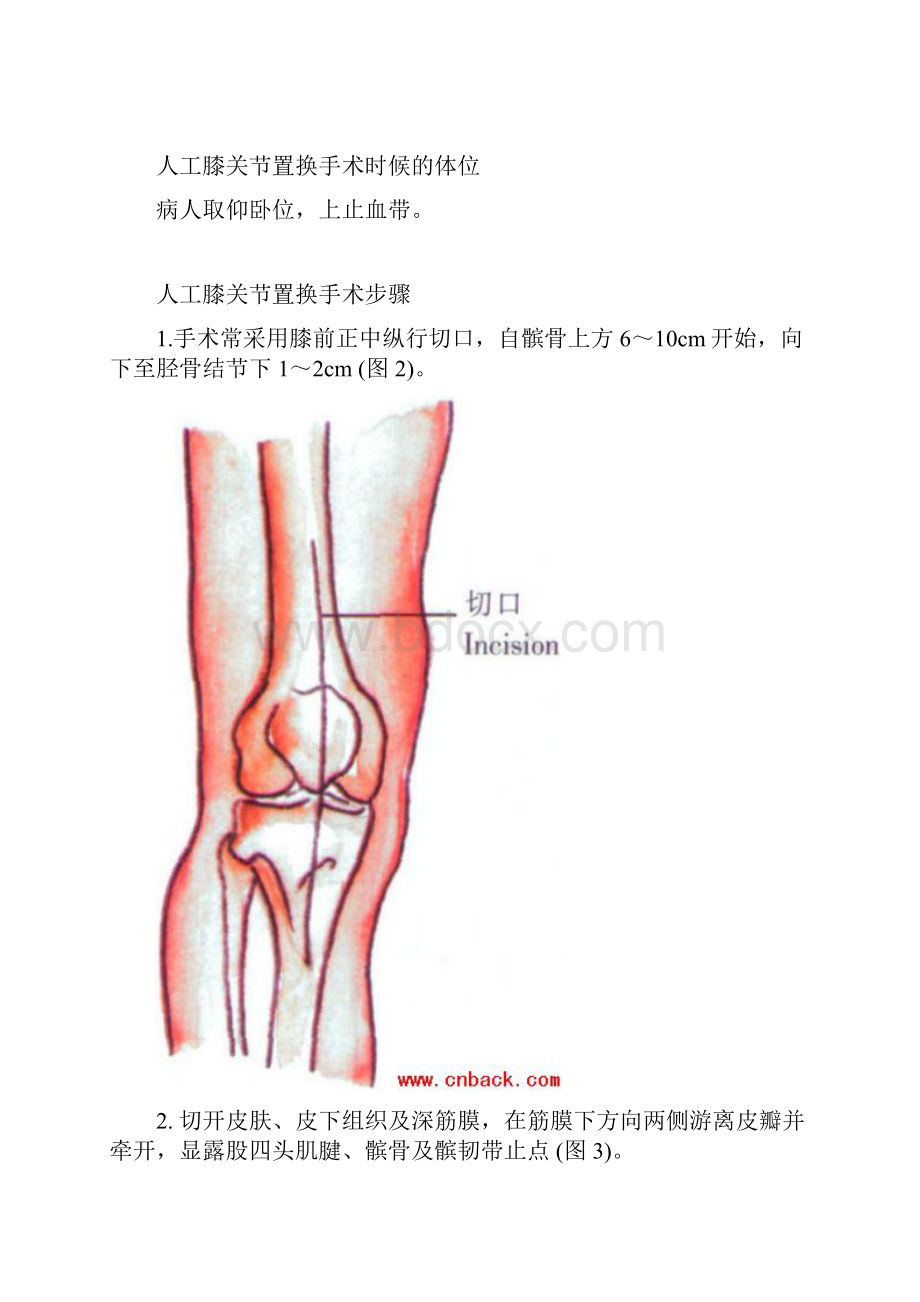 人工膝关节置换手术步骤.docx_第3页