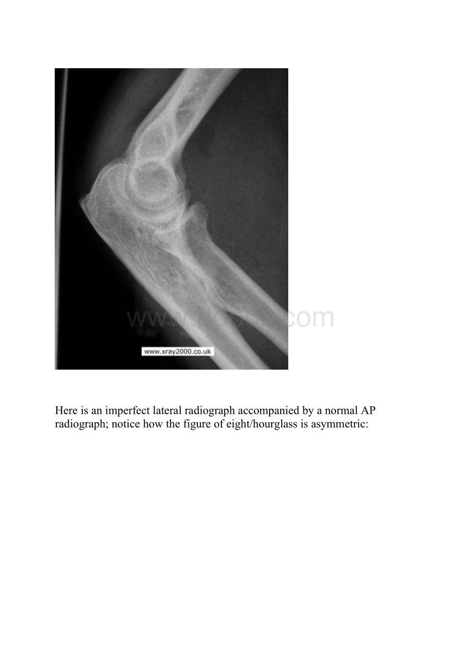 肘关节损伤X线平片阅读技巧.docx_第2页