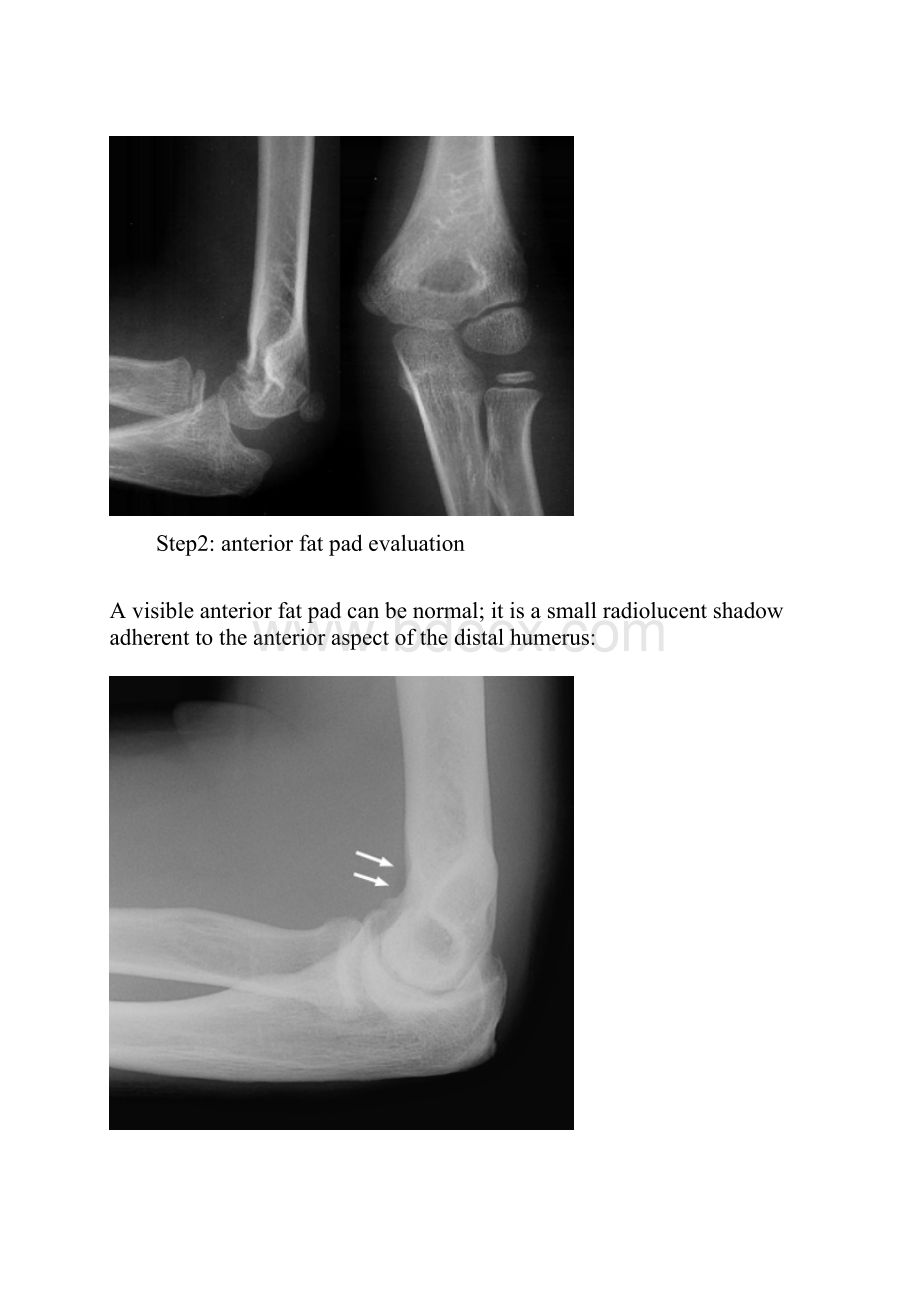 肘关节损伤X线平片阅读技巧.docx_第3页