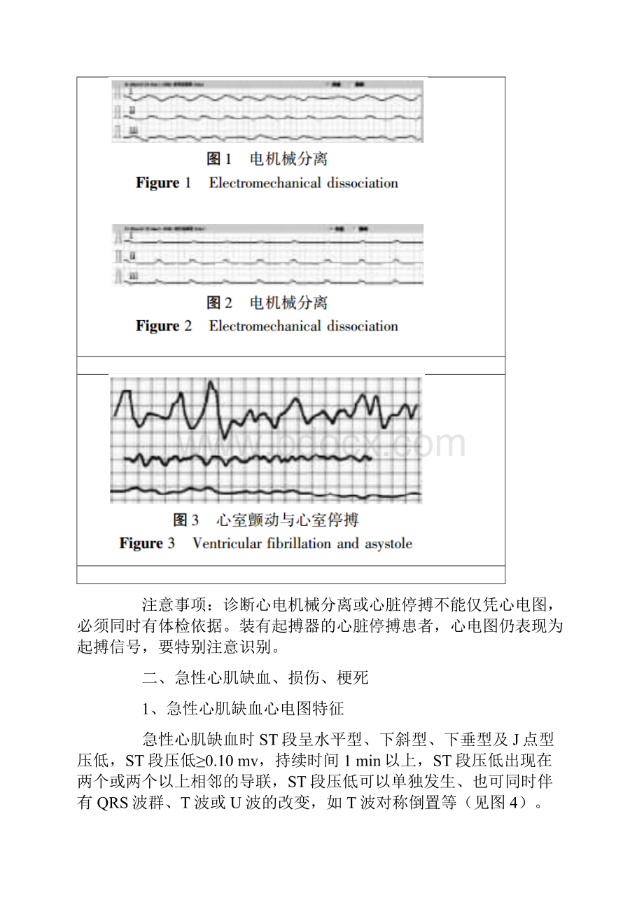 详解临床常见心电图危急值识别Word格式.docx_第2页