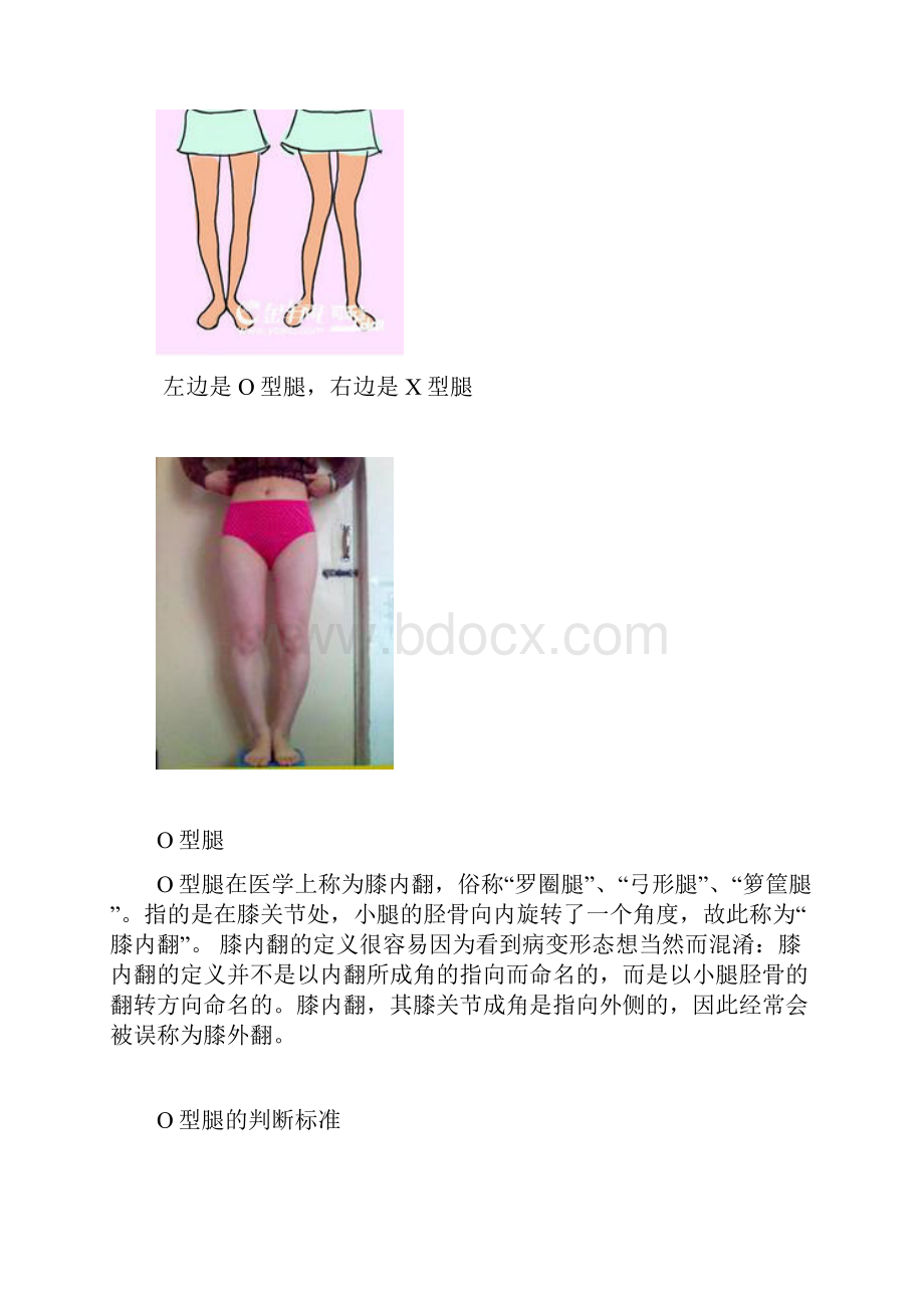 整理O型腿和X型腿的矫正方法.docx_第2页