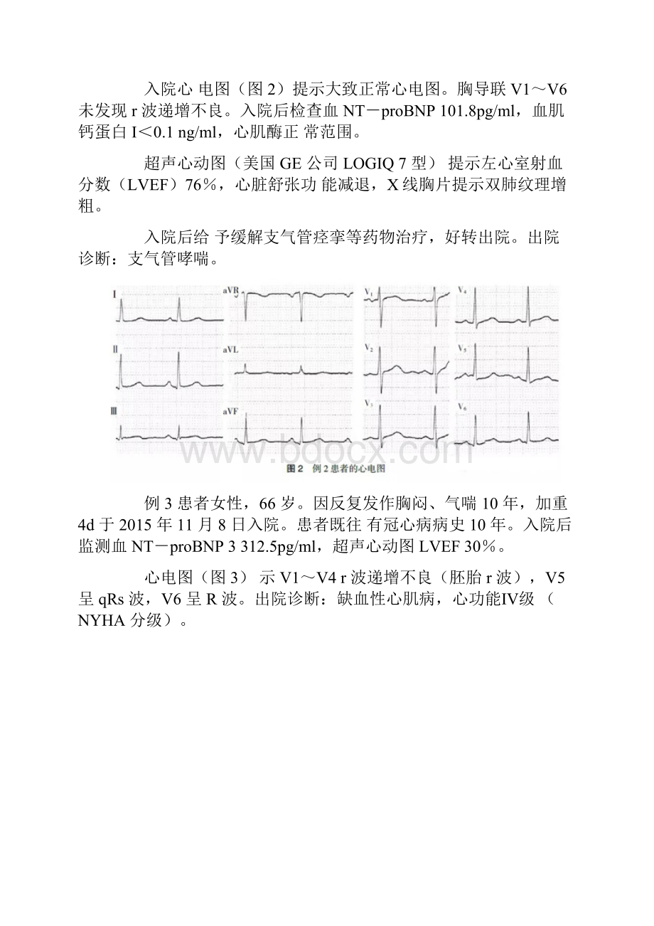 r波递增不良新概念掉头现象通过心电图诊断心力衰竭探讨全文Word格式文档下载.docx_第2页